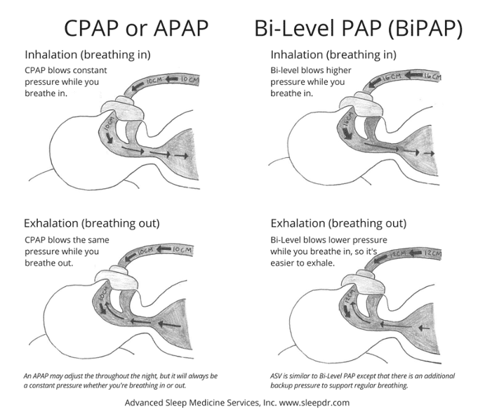 CPAP vs BiPAP